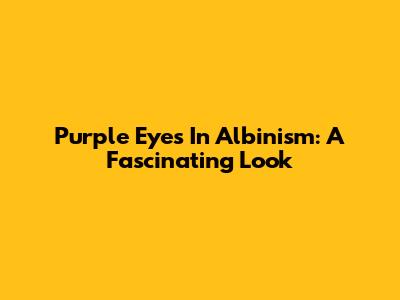 Purple Eyes In Albinism: A Fascinating Look